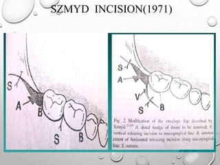 SZMYD INCISION(1971)
 