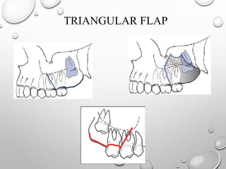 TRIANGULAR FLAP
 