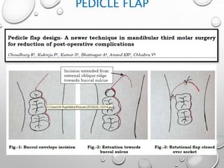 PEDICLE FLAP
 