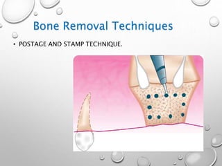 • POSTAGE AND STAMP TECHNIQUE.
Bone Removal Techniques
 