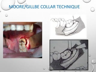 MOORE/GILLBE COLLAR TECHNIQUE
 