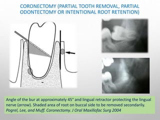 CORONECTOMY (PARTIAL TOOTH REMOVAL, PARTIAL
ODONTECTOMY OR INTENTIONAL ROOT RETENTION)
Angle of the bur at approximately 45° and lingual retractor protecting the lingual
nerve (arrow). Shaded area of root on buccal side to be removed secondarily.
Pogrel, Lee, and Muff. Coronectomy. J Oral Maxillofac Surg 2004
 