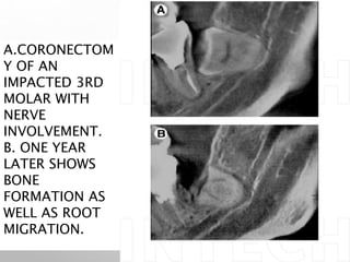 A.CORONECTOM
Y OF AN
IMPACTED 3RD
MOLAR WITH
NERVE
INVOLVEMENT.
B. ONE YEAR
LATER SHOWS
BONE
FORMATION AS
WELL AS ROOT
MIGRATION.
 