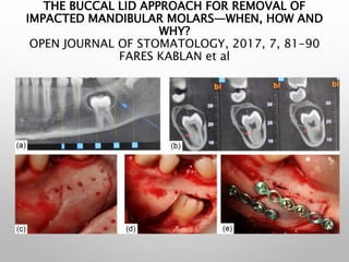 THE BUCCAL LID APPROACH FOR REMOVAL OF
IMPACTED MANDIBULAR MOLARS—WHEN, HOW AND
WHY?
OPEN JOURNAL OF STOMATOLOGY, 2017, 7, 81-90
FARES KABLAN et al
 