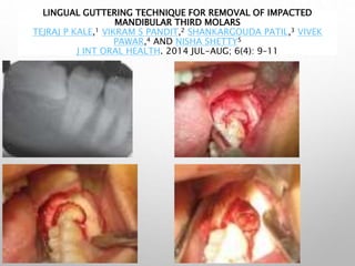 LINGUAL GUTTERING TECHNIQUE FOR REMOVAL OF IMPACTED
MANDIBULAR THIRD MOLARS
TEJRAJ P KALE,1 VIKRAM S PANDIT,2 SHANKARGOUDA PATIL,3 VIVEK
PAWAR,4 AND NISHA SHETTY5
J INT ORAL HEALTH. 2014 JUL-AUG; 6(4): 9–11
 