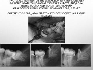 TWO-STAGE METHOD FOR THE EXTRACTION OF A HORIZONTALLY
IMPACTED LOWER THIRD MOLAR YASUTAKA KUBOTA, SHOJI OKA,
YOSHIE YAHARA AND KANEMITSU SHIRASUNA
ORAL SCIENCE INTERNATIONAL, NOVEMBER 2008, P.73-77
COPYRIGHT © 2008, JAPANESE STOMATOLOGY SOCIETY. ALL RIGHTS
RESERVED
 