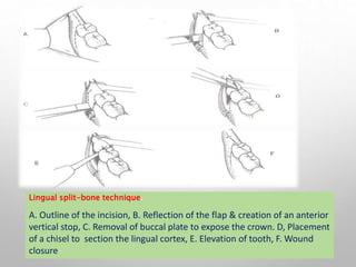 Lingual split-bone technique.
A. Outline of the incision, B. Reflection of the flap & creation of an anterior
vertical stop, C. Removal of buccal plate to expose the crown. D, Placement
of a chisel to section the lingual cortex, E. Elevation of tooth, F. Wound
closure
 
