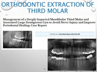ORTHODONTIC EXTRACTION OF
THIRD MOLAR
 