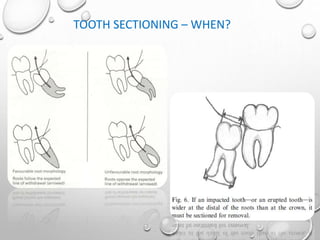 TOOTH SECTIONING – WHEN?
 