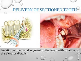 DELIVERY OF SECTIONED TOOTH
Luxation of the distal segment of the tooth with rotation of
the elevator distally.
 