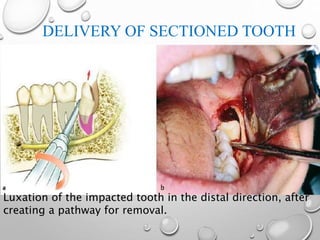 DELIVERY OF SECTIONED TOOTH
Luxation of the impacted tooth in the distal direction, after
creating a pathway for removal.
 