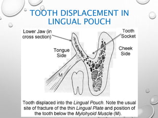 TOOTH DISPLACEMENT IN
LINGUAL POUCH
 
