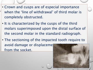 • Crown and cusps are of especial importance
when the ‘line of withdrawal’ of third molar is
completely obstructed.
• It is characterized by the cusps of the third
molars superimposed upon the distal surface of
the second molar in the standard radiograph.
• The sectioning of the impacted tooth require to
avoid damage or displacement of 2nd molar
from the socket.
 