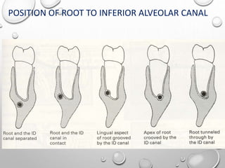 POSITION OF ROOT TO INFERIOR ALVEOLAR CANAL
 