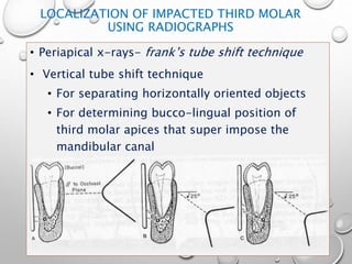LOCALIZATION OF IMPACTED THIRD MOLAR
USING RADIOGRAPHS
• Periapical x-rays- frank’s tube shift technique
• Vertical tube shift technique
• For separating horizontally oriented objects
• For determining bucco-lingual position of
third molar apices that super impose the
mandibular canal
 
