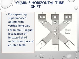 CLARK’S HORIZONTAL TUBE
SHIFT
• For separating
superimposed
objects with
vertical long axis
• For buccal / lingual
localization of
impacted third
molar from roots of
erupted teeth
 