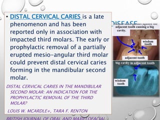PREVENTION OF DENTAL DISEASE
• DISTAL CERVICAL CARIES is a late
phenomenon and has been
reported only in association with
impacted third molars. The early or
prophylactic removal of a partially
erupted mesio-angular third molar
could prevent distal cervical caries
forming in the mandibular second
molar.
DISTAL CERVICAL CARIES IN THE MANDIBULAR
SECOND MOLAR: AN INDICATION FOR THE
PROPHYLACTIC REMOVAL OF THE THIRD
MOLAR?
LOUIS W. MCARDLE∗, TARA F. RENTON
 