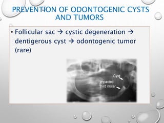 PREVENTION OF ODONTOGENIC CYSTS
AND TUMORS
• Follicular sac  cystic degeneration 
dentigerous cyst  odontogenic tumor
(rare)
 