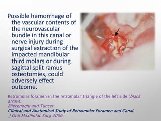 Possible hemorrhage of
the vascular contents of
the neurovascular
bundle in this canal or
nerve injury during
surgical extraction of the
impacted mandibular
third molars or during
sagittal split ramus
osteotomies, could
adversely effect
outcome.
Retromolar foramen in the retromolar triangle of the left side (black
arrow).
Bilecenoglu and Tuncer.
Clinical and Anatomical Study of Retromolar Foramen and Canal.
J Oral Maxillofac Surg 2006.
 