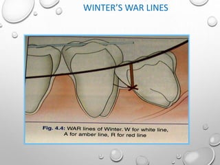 WINTER’S WAR LINES
 