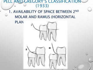 PELL AND GREGORY’S CLASSIFICATION
(1933)
1. AVAILABILITY OF SPACE BETWEEN 2ND
MOLAR AND RAMUS (HORIZONTAL
PLANE)
 