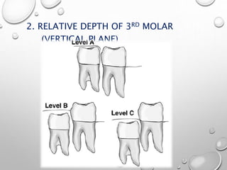 2. RELATIVE DEPTH OF 3RD MOLAR
(VERTICAL PLANE)
 