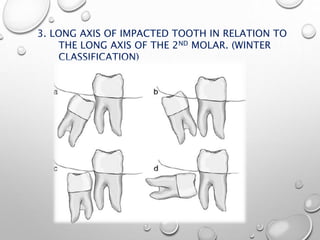 3. LONG AXIS OF IMPACTED TOOTH IN RELATION TO
THE LONG AXIS OF THE 2ND MOLAR. (WINTER
CLASSIFICATION)
 
