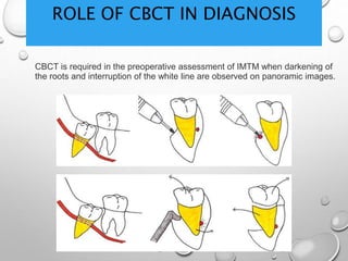 ROLE OF CBCT IN DIAGNOSIS
CBCT is required in the preoperative assessment of IMTM when darkening of
the roots and interruption of the white line are observed on panoramic images.
 