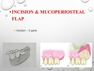 •INCISION & MUCOPERIOSTEAL
FLAP
 Incision – 3 parts
 