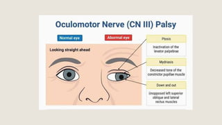 THIRD NERVE PALSY -OPHTHALMOLOGY POST GR | PPTX