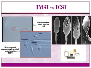 IMSI VS ICSI
 