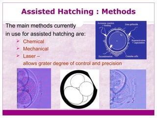 Assisted Hatching : Methods
The main methods currently
in use for assisted hatching are:
 Chemical
 Mechanical
 Laser –
allows grater degree of control and precision
 