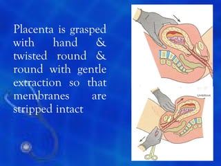 Placenta is grasped
with hand &
twisted round &
round with gentle
extraction so that
membranes        are
stripped intact


                       16
 