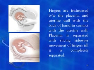 Fingers are insinuated
b/w the placenta and
uterine wall with the
back of hand in contact
with the uterine wall.
Placenta is separated
with slicing sideways
movement of fingers till
it    is    completely
separated.

                      32
 