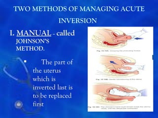 TWO METHODS OF MANAGING ACUTE
                 INVERSION
I. MANUAL – called
 JOHNSON’S
 METHOD.

          The part of
       the uterus
       which is
       inverted last is
       to be replaced
       first
                                 55
 