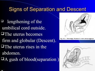 Third stage of labor for undergraduate | PPT