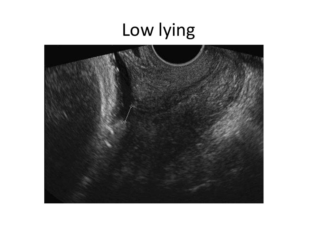 ultrasound of second and third trimester bleeding