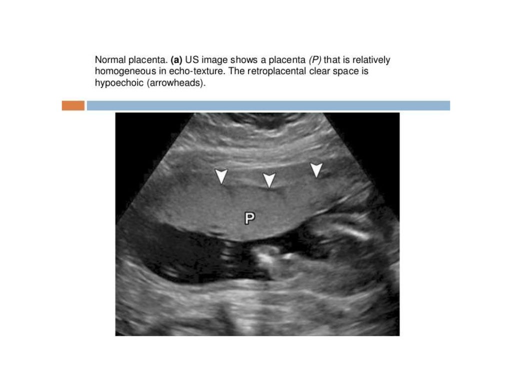 ultrasound of second and third trimester bleeding