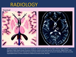 RADIOLOGY
• (Left) Axial graphic shows frontal horns of lateral entricles (arrows), fornix (open white arrow), septum
ellucidum (open black arrow), foramen of Monro urved arrow) opening into 3rd ventricle. (Right) Axial T2WI
MR shows ventricles at 3T. Frontal horns (arrows), third ventricle (open arrow) are indicated. Fornices are avily
myelinated tracts in front of foramen of Monro (curved arrow). Normal
 