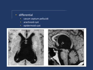 • differential
• cavum septum pellucidi
• arachnoid cyst
• epidermoid cyst
 