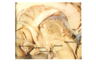 Optic chiasm
Hypothalamus
Mamillary body
Tegmentum
Peduncle
 