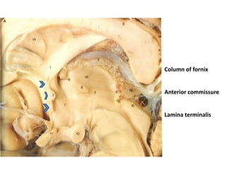 Column of fornix
Anterior commissure
Lamina terminalis
 