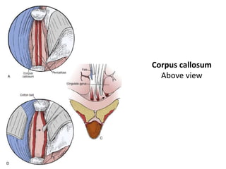 Corpus callosum
Above view
 