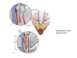 Opening the corpus
callosum (CC)
 