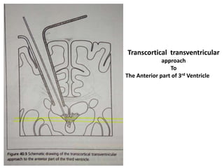 Transcortical transventricular
approach
To
The Anterior part of 3rd Ventricle
 