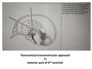 Transcortical transventricular approach
To
Anterior part of 3rd ventricle
 