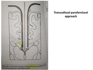 Transcallosal paraforniceal
approach
 