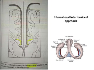 Intercallosal Interforniceal
approach
 