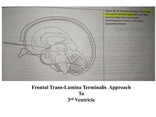 Frontal Trans-Lamina Terminalis Approach
To
3rd Ventricle
 