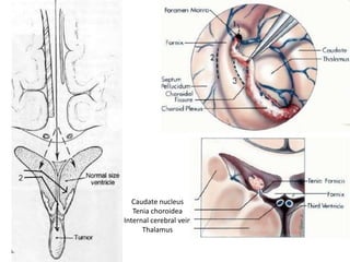 Caudate nucleus
Tenia choroidea
Internal cerebral vein
Thalamus
 